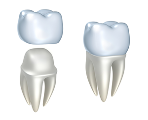 dental crowns | Dentist In Camarillo, CA | R.A. Richards II